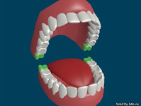 Лечение зуба мудрости, Distoped 8,Дистопированнвя 8, Discrete Toothof