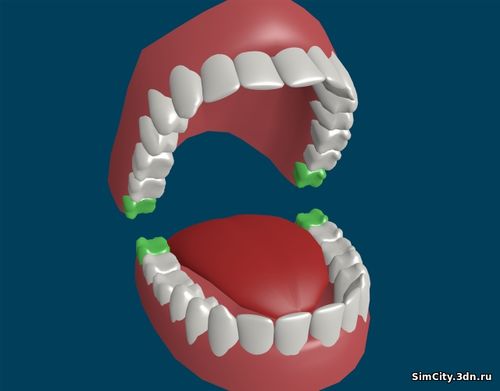 Лечение зуба мудрости, Distoped 8,Дистопированнвя 8, Discrete Toothof